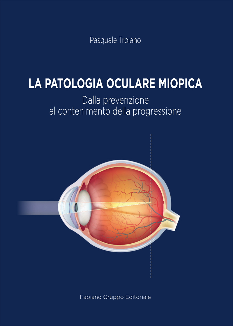 patologia_oculare_miopica